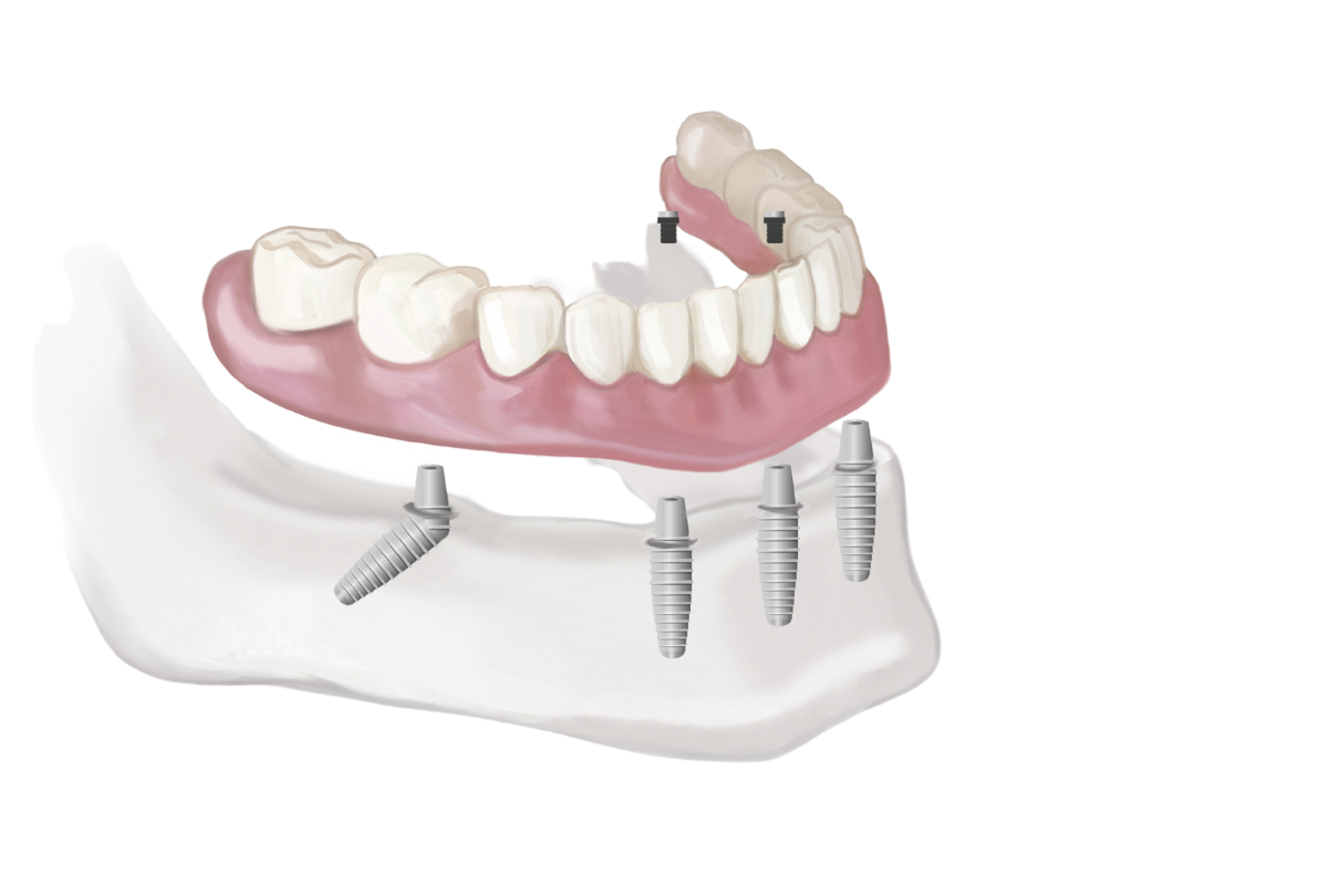 Full Mouth Dental Implants